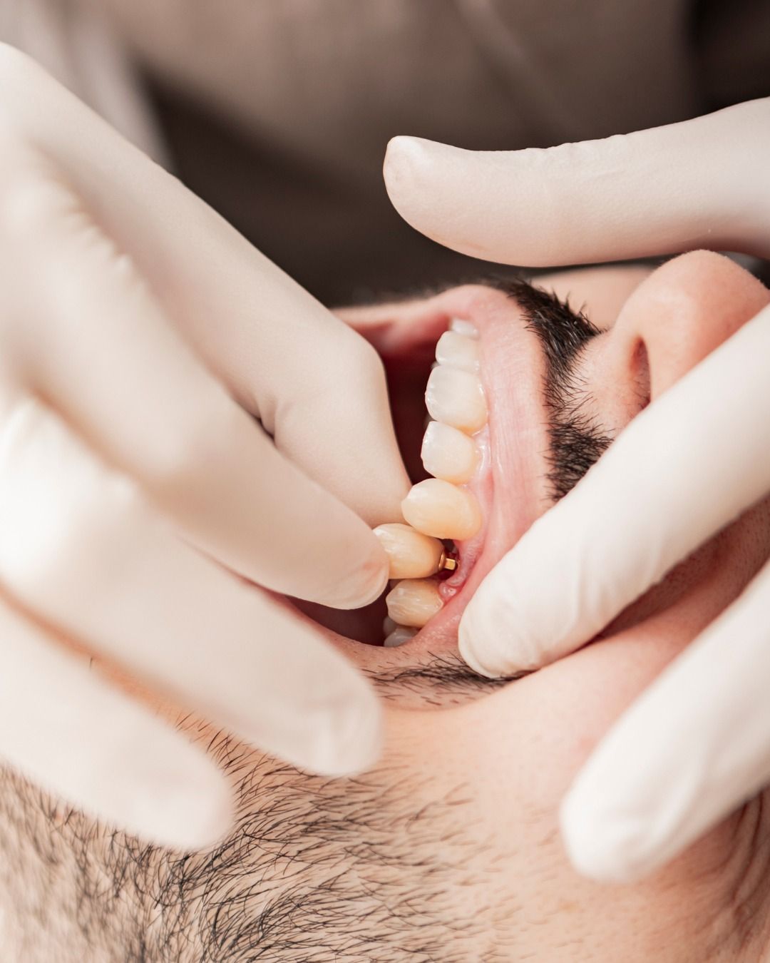 Implante Dental + Corona