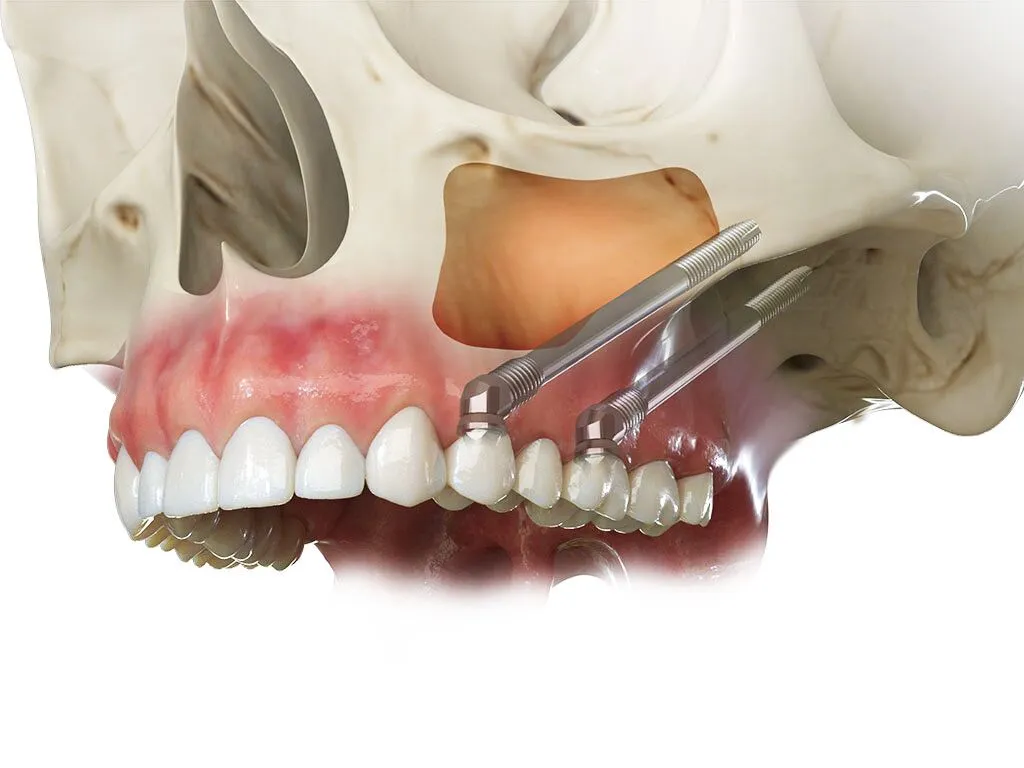 Implantes Cigomáticos