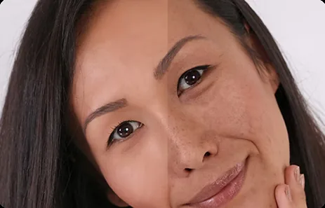 Spider Vein Removal