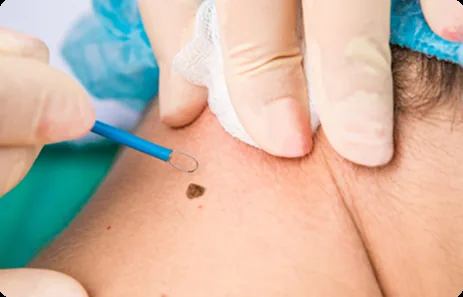 Vaginal Rejuvenation