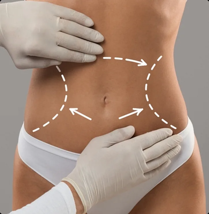 Muscle Sculpting Treatment