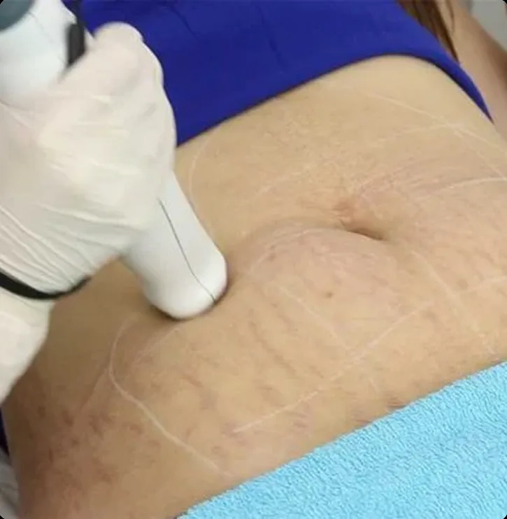 Stretch Mark Treatment