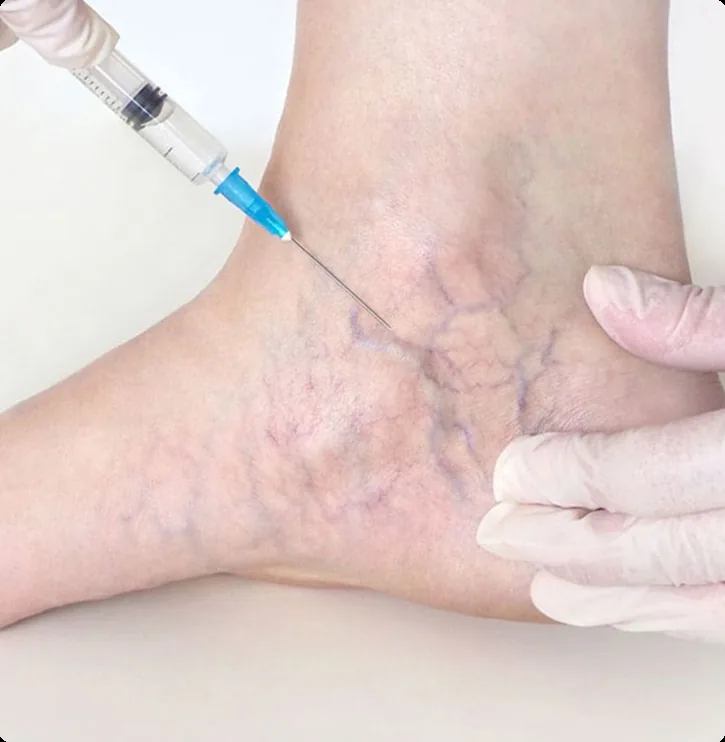 Spider Vein Treatment
