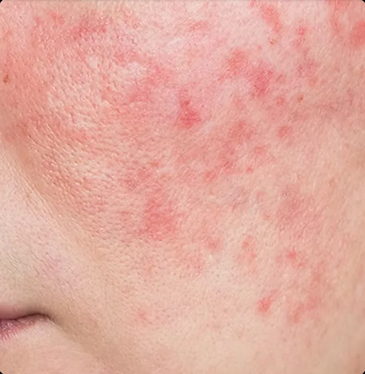 Redness & Rosacea Treatment