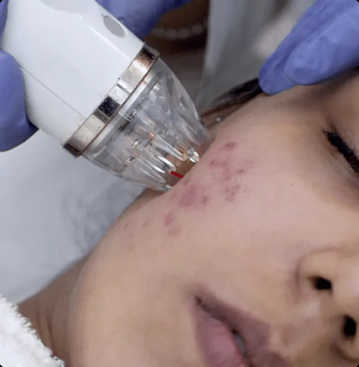 Acne Scar Treatment in Bellevue