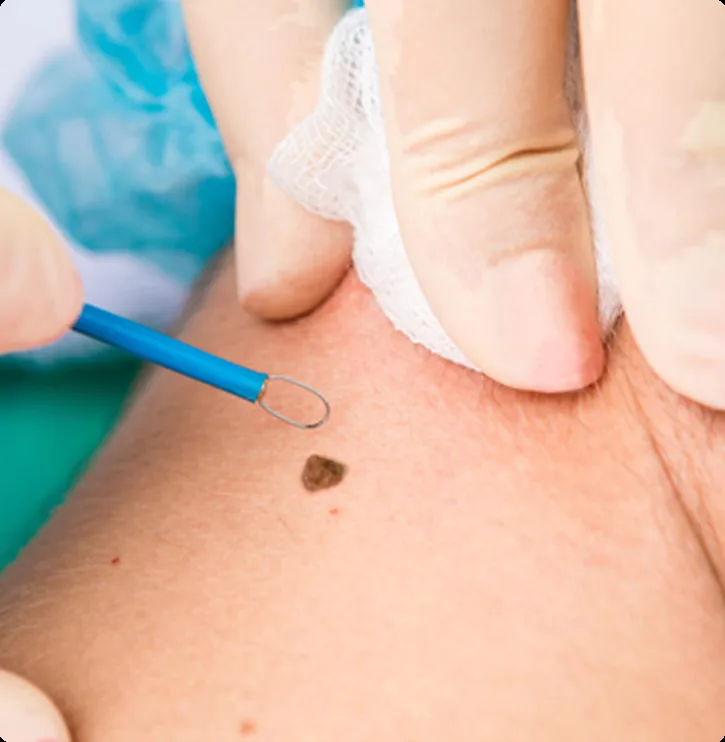 Lesion Removal Treatment