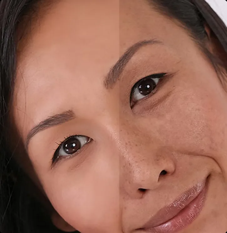 Sun Damage Treatment