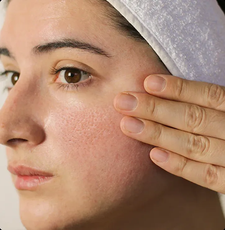 Enlarged Pores Treatment in Bellevue