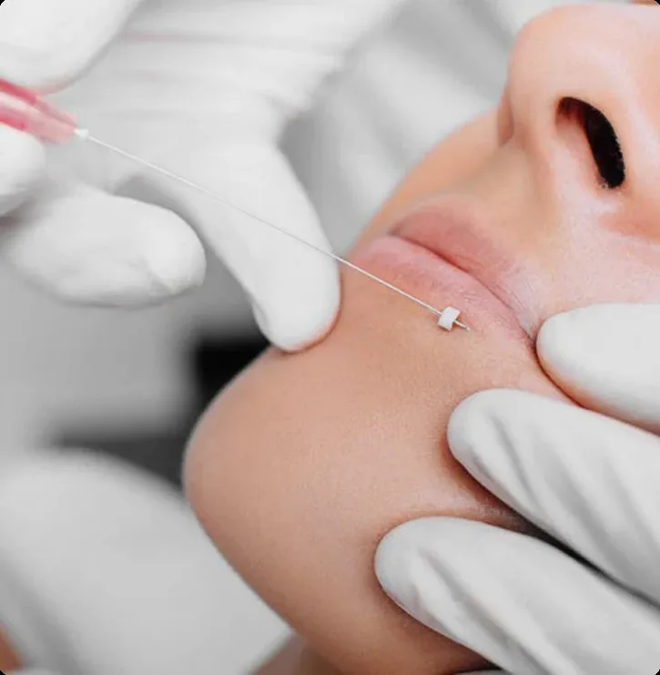 Lip thread lift treatment at Natural Rejuvenation Med Spa in Bellevue.