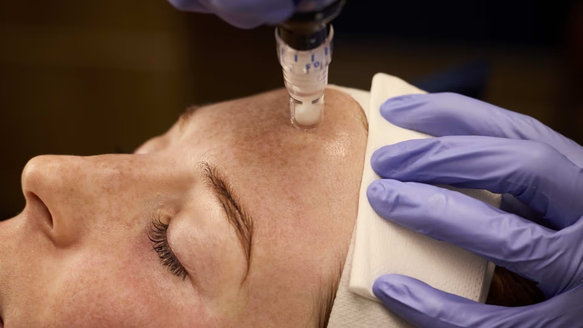 SkinPen manufacturer demonstration
