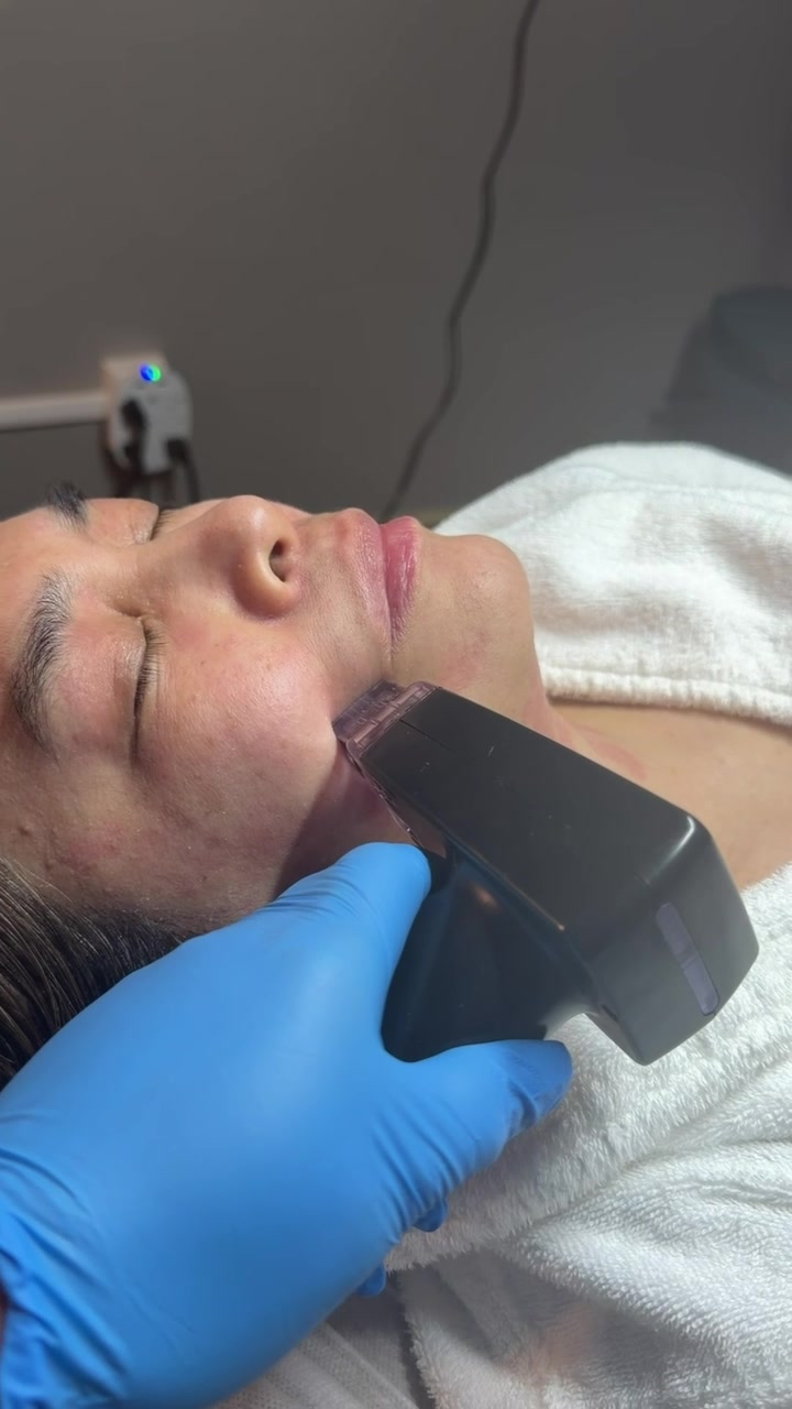 Facial treatment along the cheek and jawline at Natural Rejuvenation MedSpa