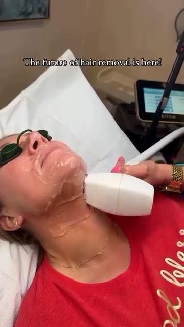 Triton laser hair removal treatment beneath the chin