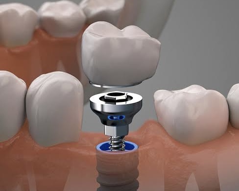 CliniKR Implantes