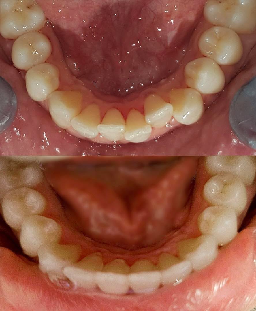 Before and after Invisalign treatment - patient 3