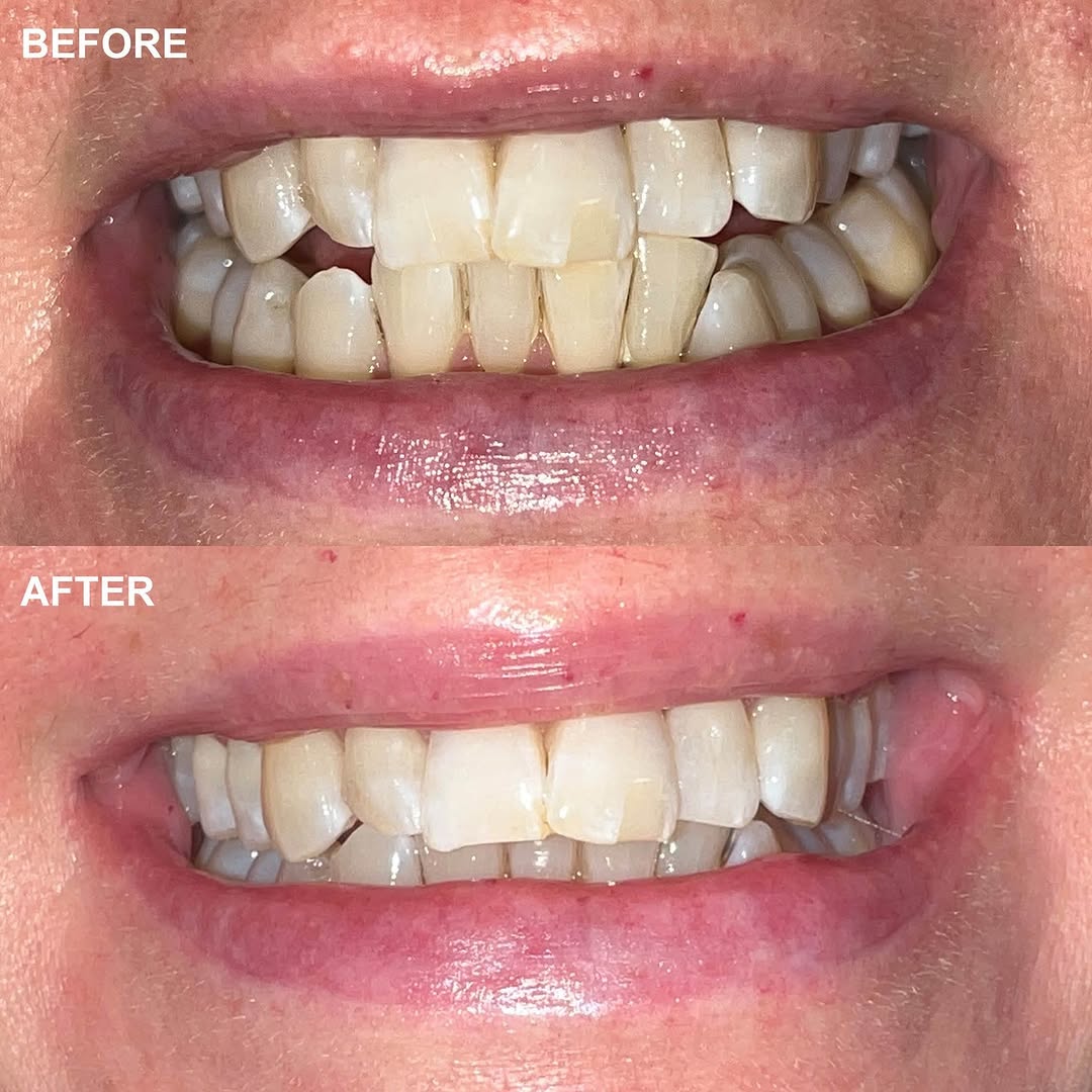 Before and after Invisalign treatment - patient 2
