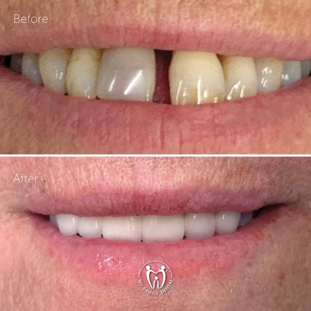 Before and after Invisalign treatment - patient 1