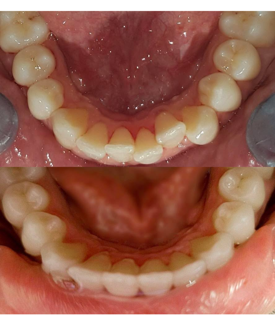 Before and after clear aligner treatment - patient 3