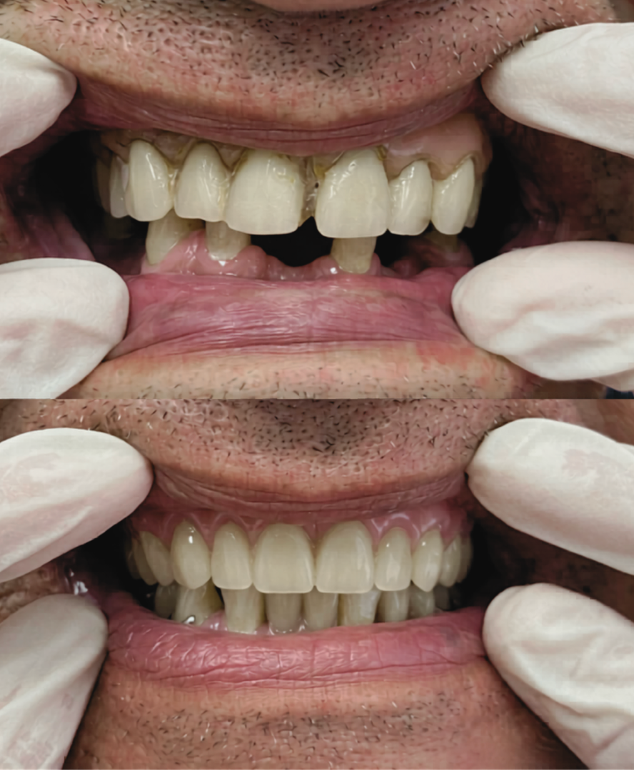 Before and after clear aligner treatment - patient 1