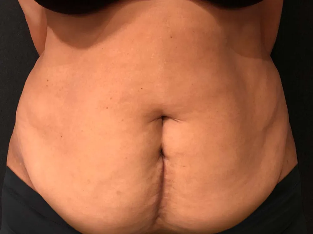 Caso 3 — antes de abdominoplastia con lipoaspiración