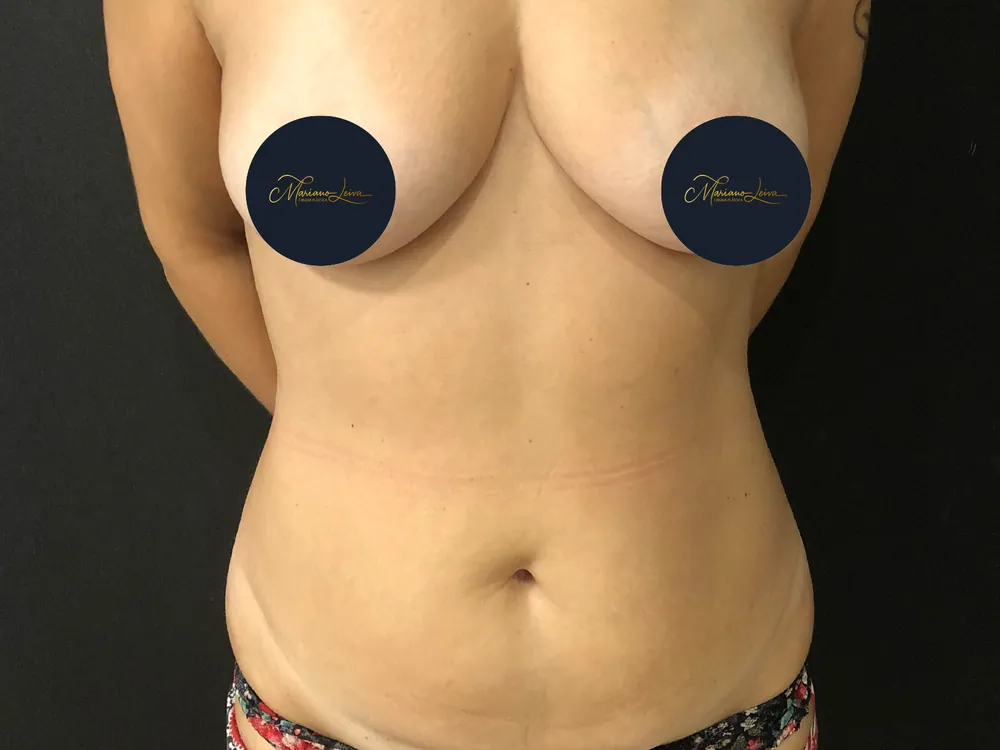 Caso 2 — antes de lipoabdominoplastia con mastopexia
