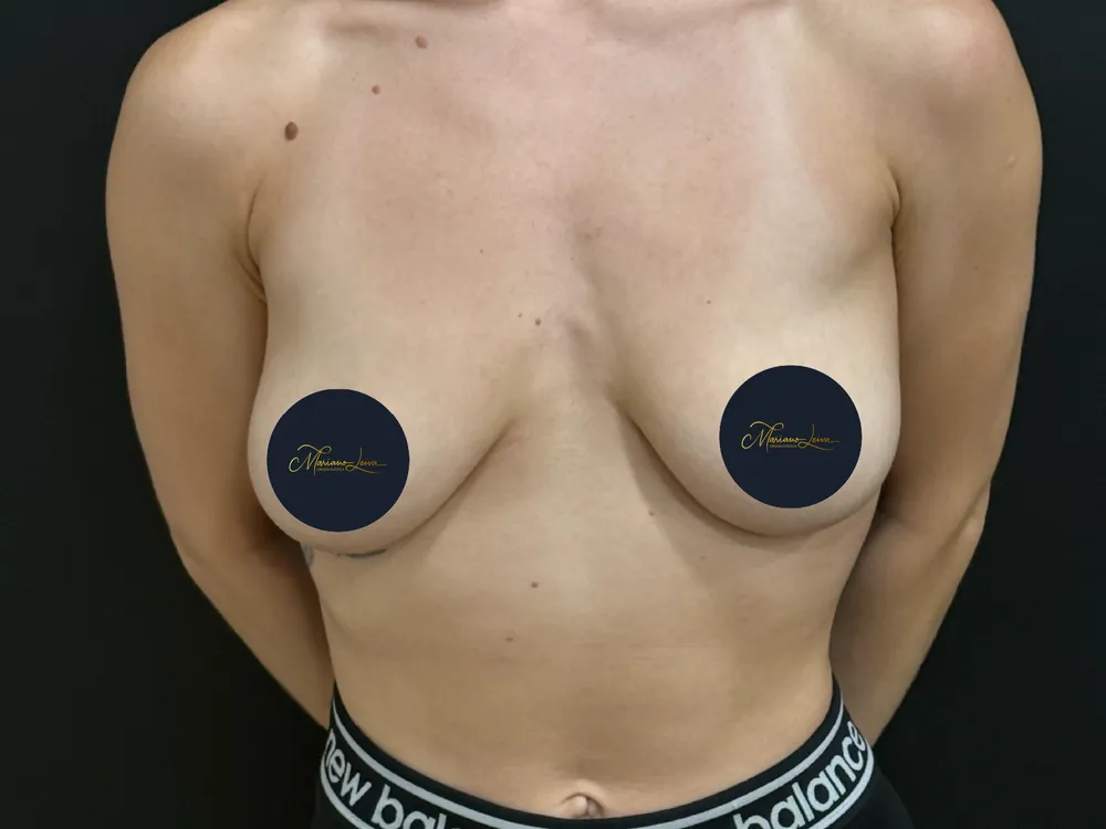 Caso 1 — antes de mastopexia con implantes