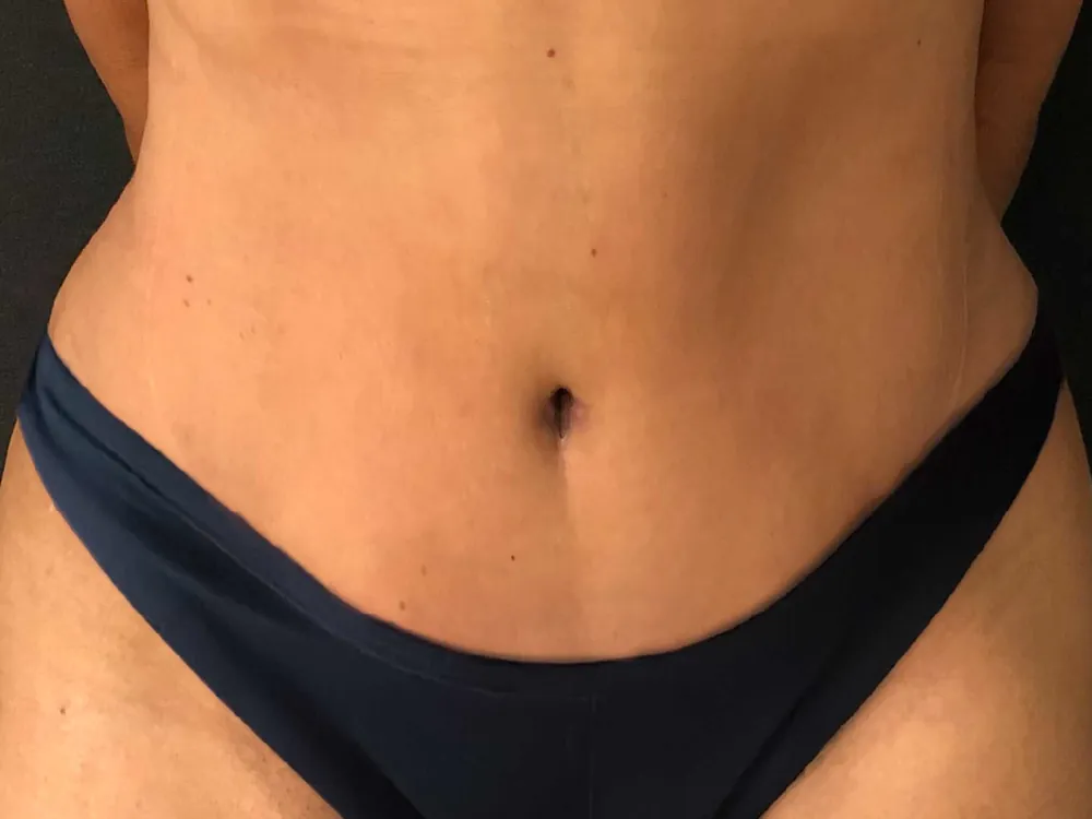 Caso 3 — después de abdominoplastia con lipoaspiración