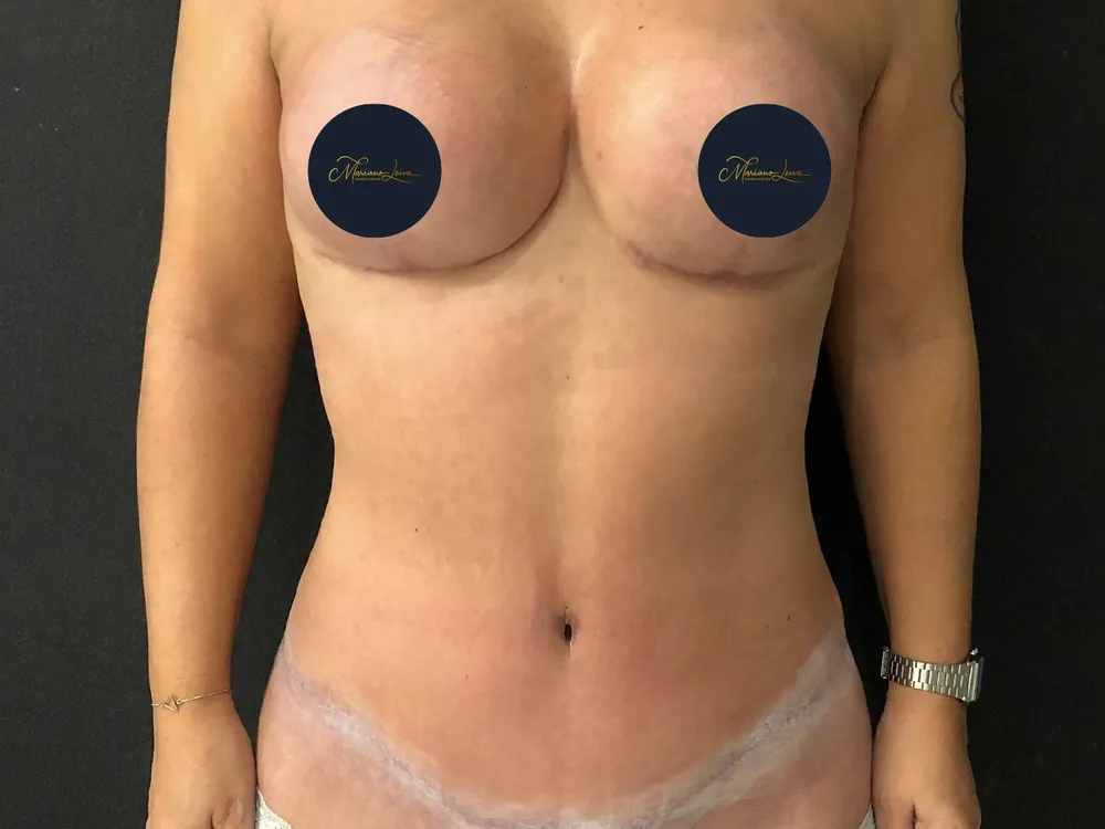 Caso 2 — después de lipoabdominoplastia con mastopexia