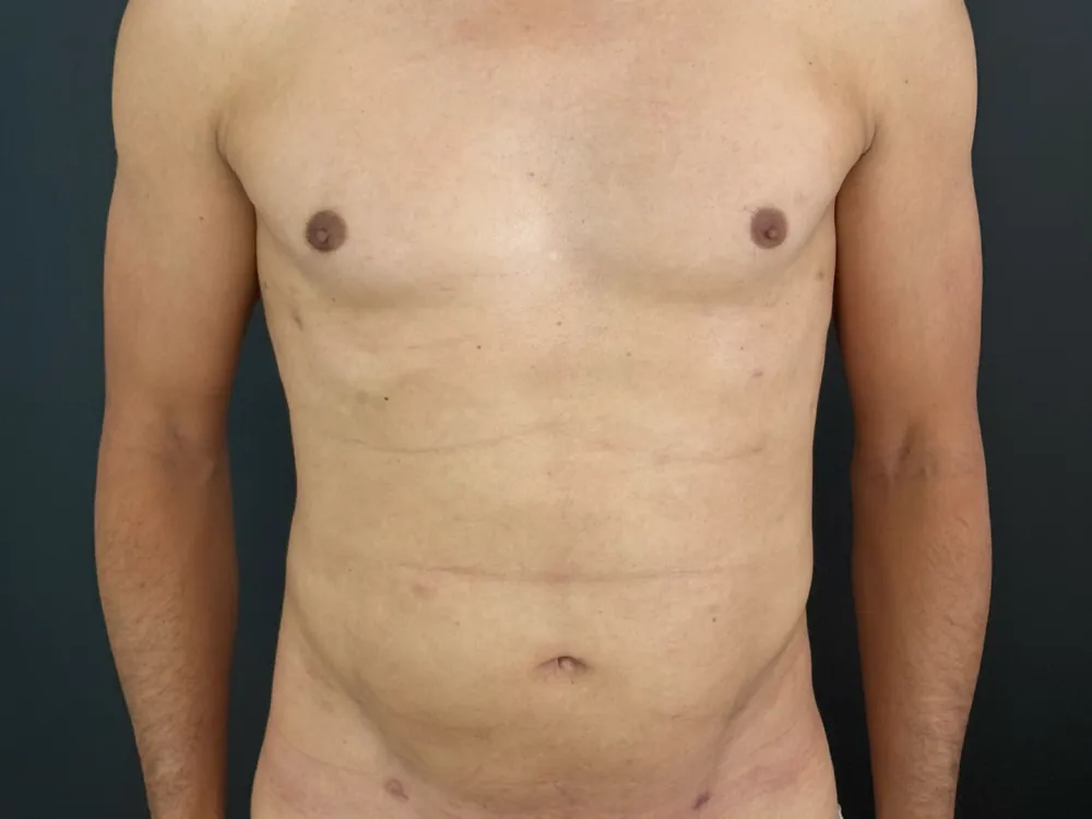 Caso 4 — después de corrección de ginecomastia con lipoaspiración