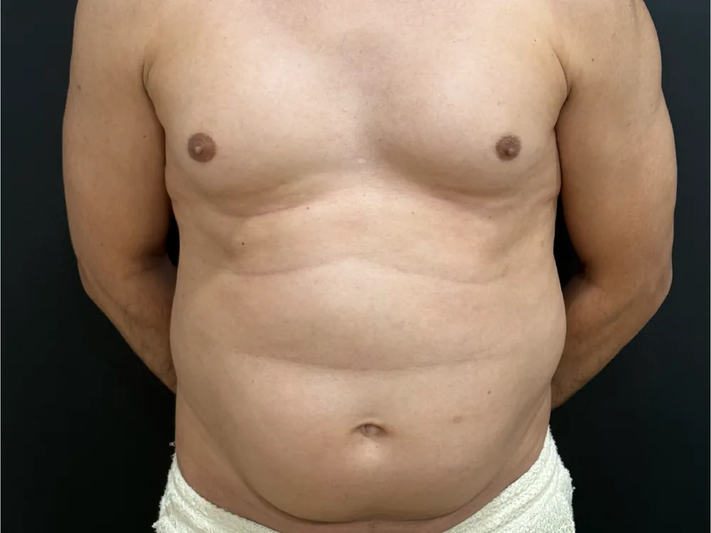 Caso 4 — antes de corrección de ginecomastia con lipoaspiración