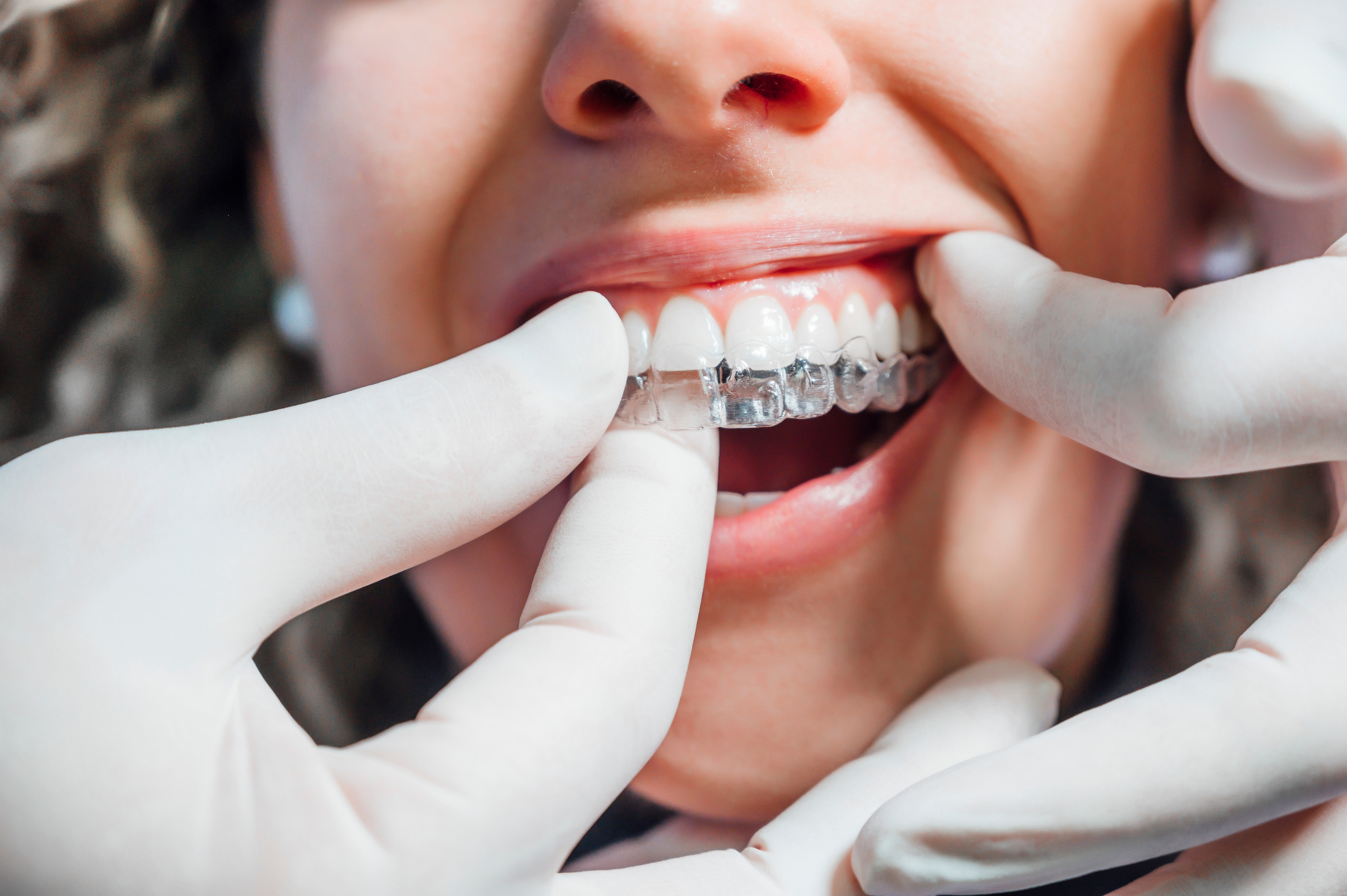 Custom clear aligners