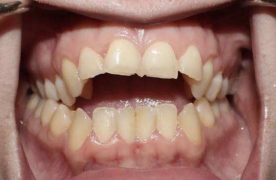 Open bite corrected by Invisalign
