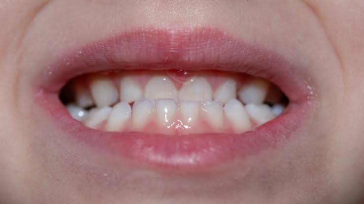 Underbite corrected by Invisalign