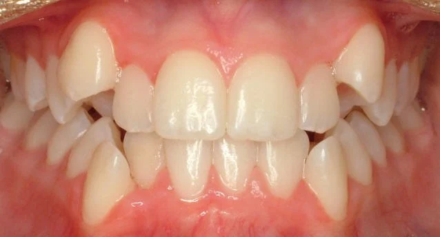 Crowded teeth corrected by Invisalign