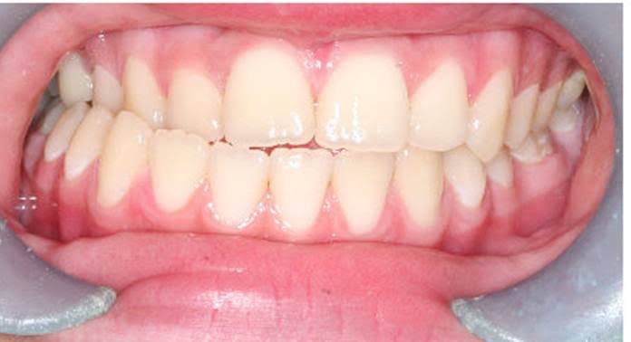 Crossbite corrected by Invisalign