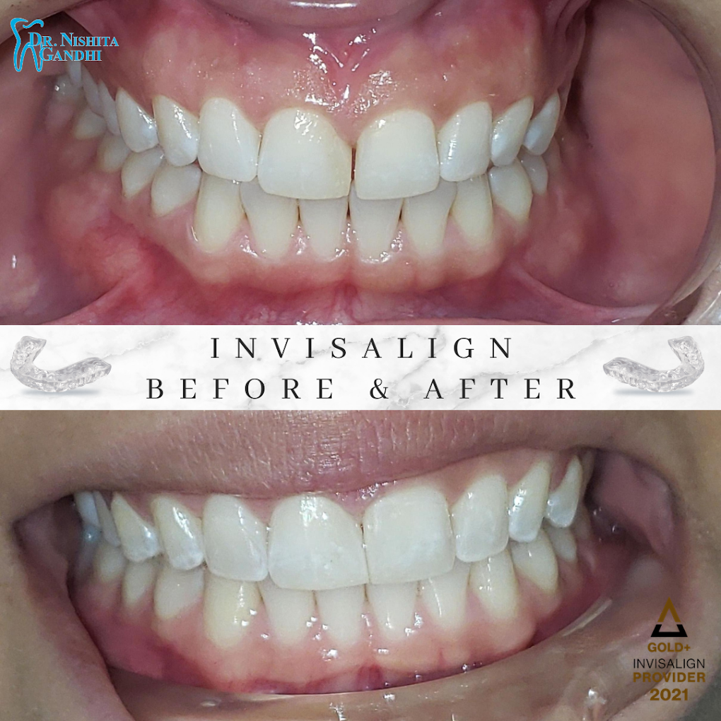 Invisalign patient before and after results