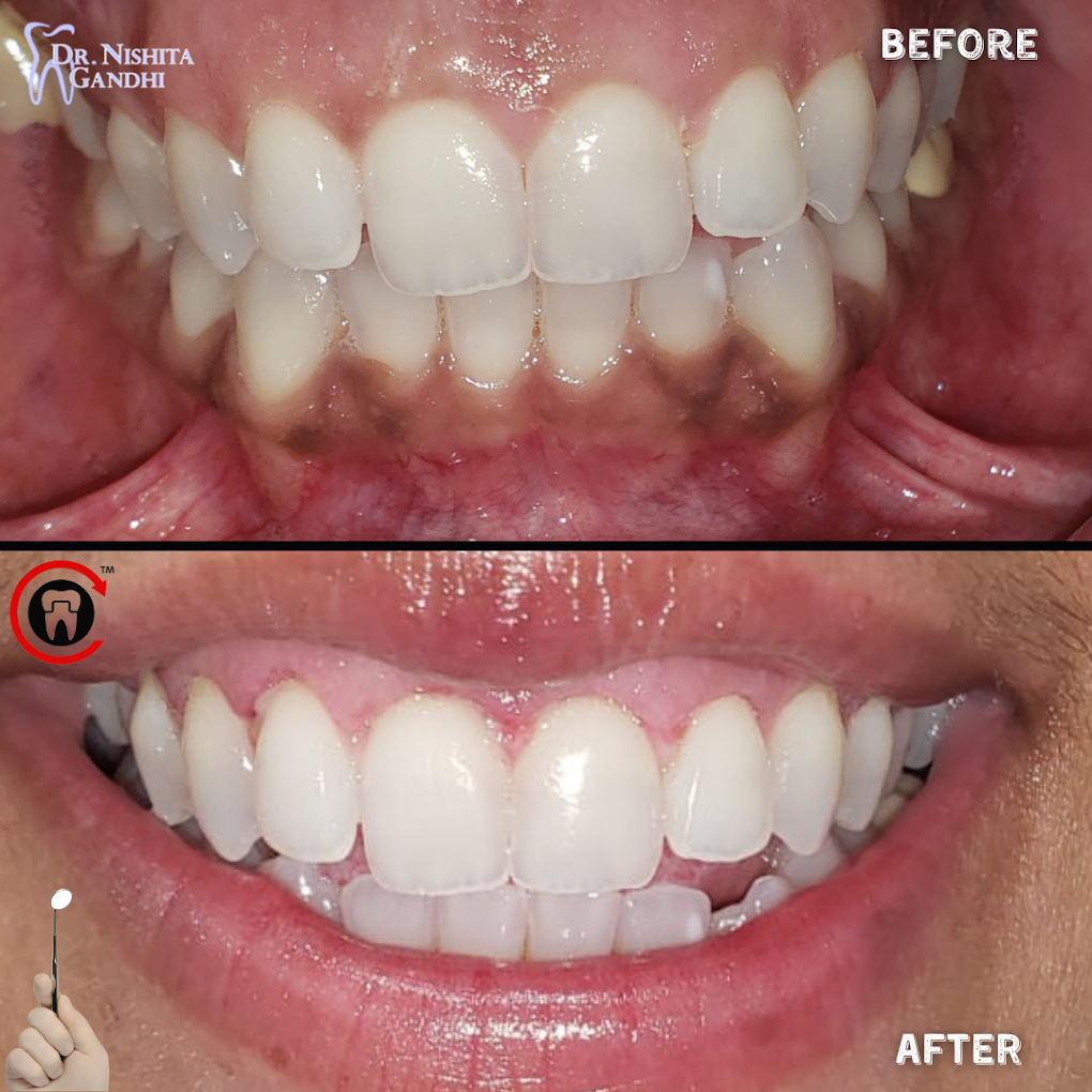Invisalign patient before and after results