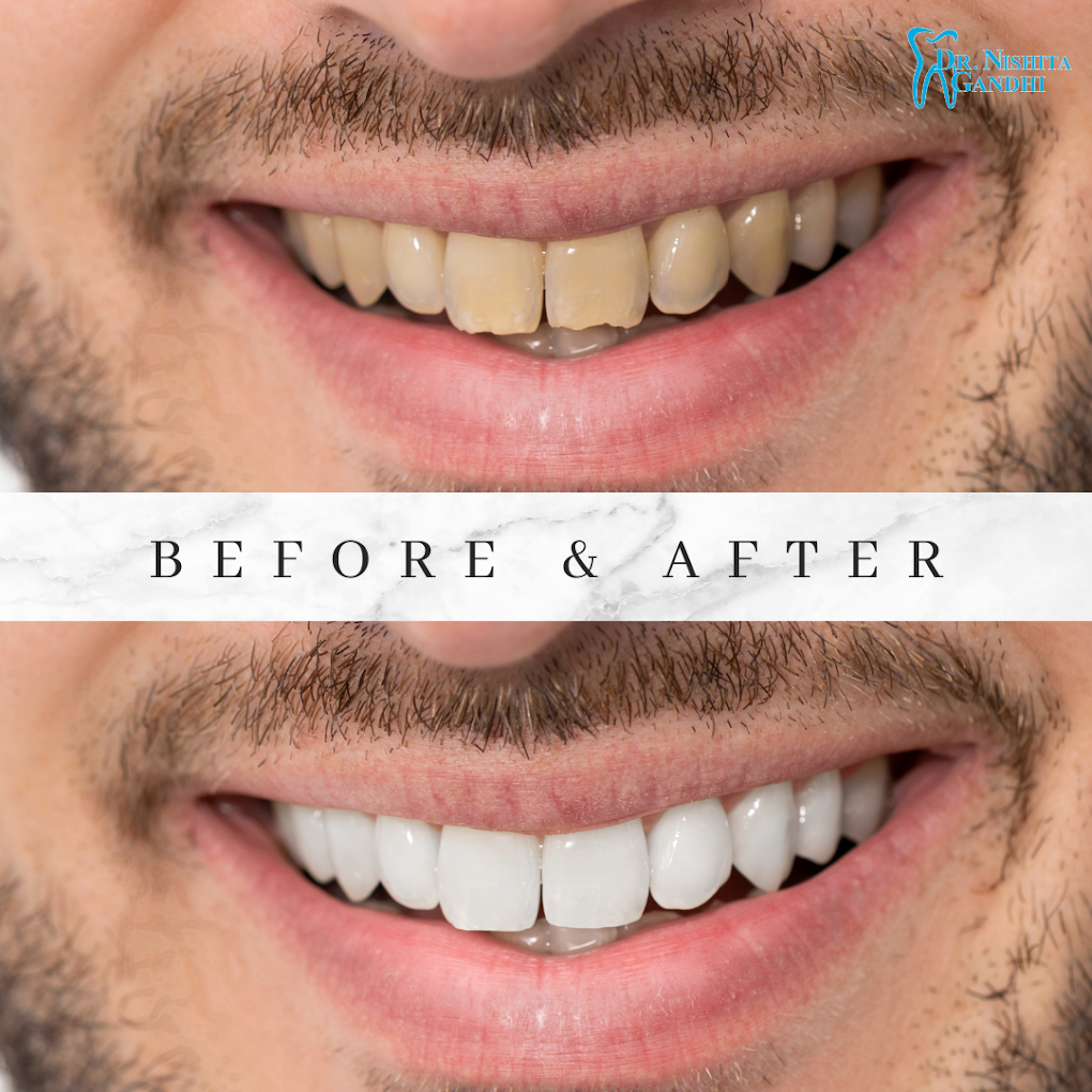 Invisalign patient before and after results