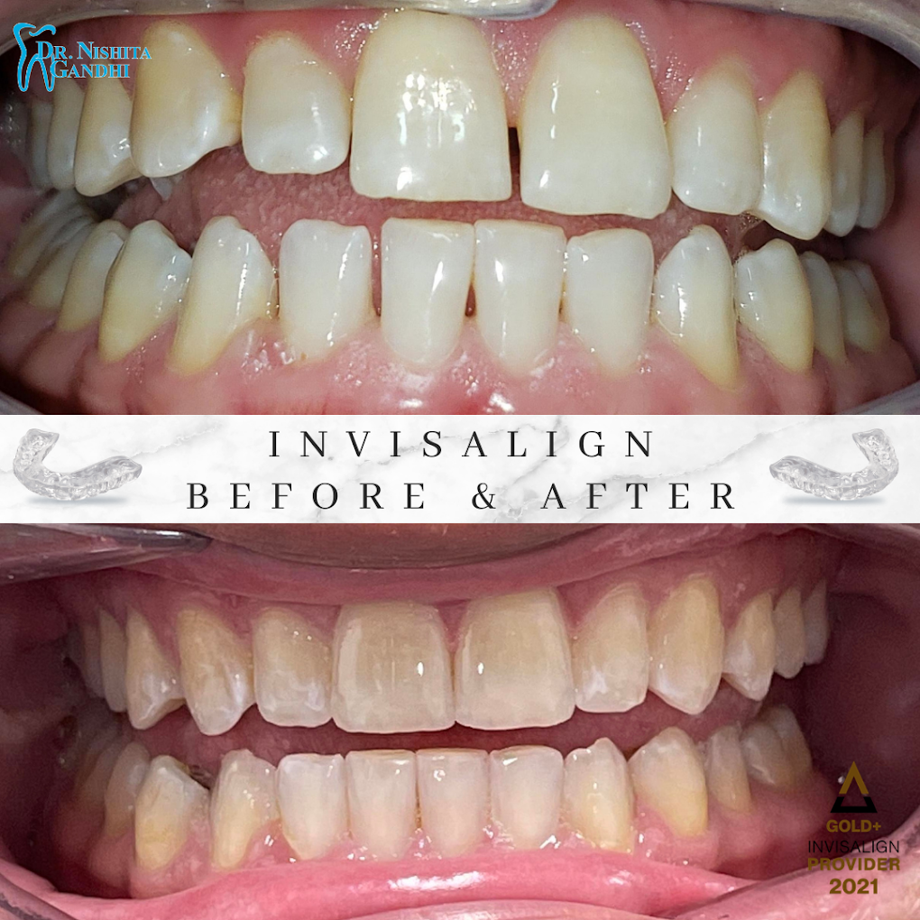 Invisalign patient before and after results