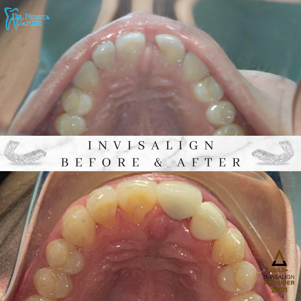 Invisalign patient before and after results