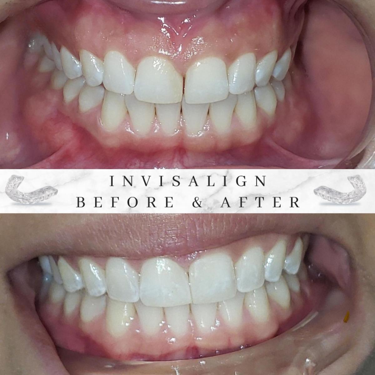 Invisalign patient before and after results