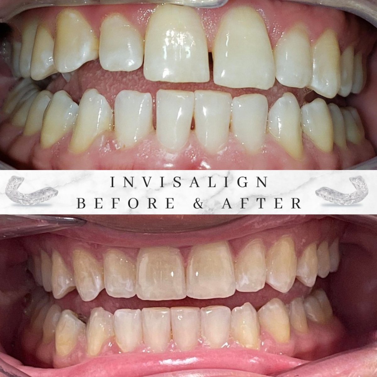 Invisalign patient before and after results