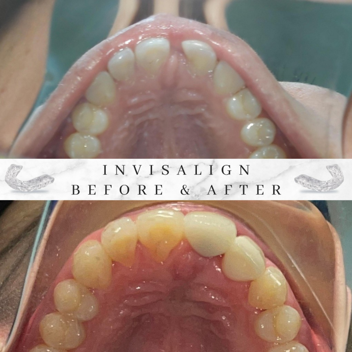 Invisalign patient before and after results