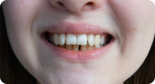 Overbite corrected by Invisalign
