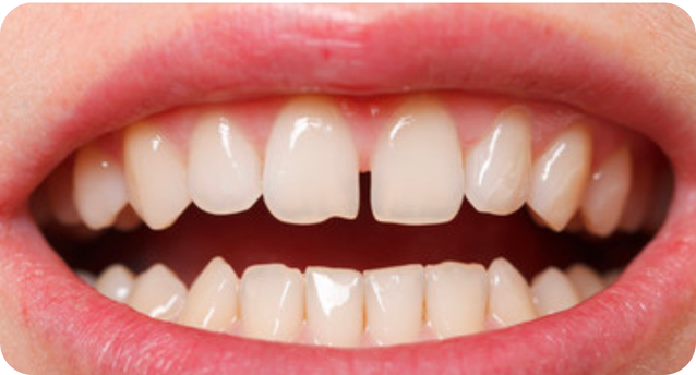 Gap teeth corrected by Invisalign