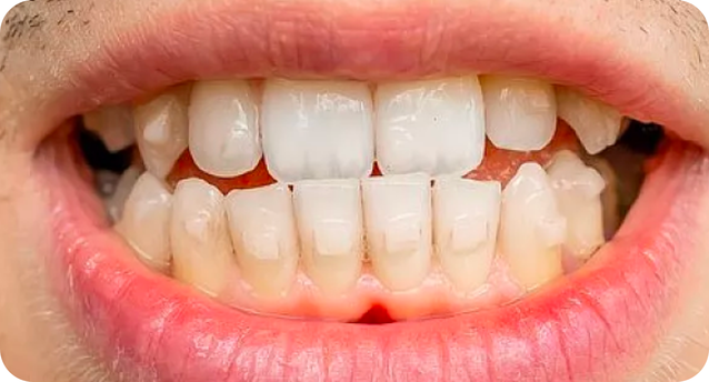 Underbite corrected by Invisalign