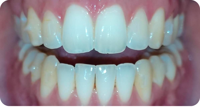 Open bite corrected by Invisalign