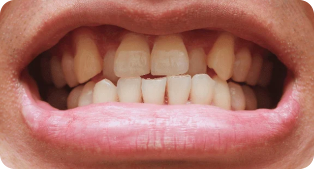 Crossbite corrected by Invisalign