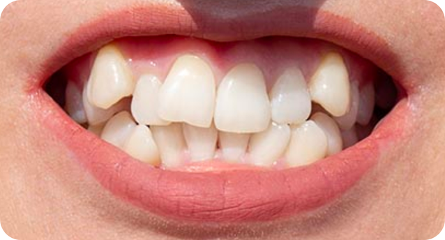 Crowded teeth corrected by Invisalign