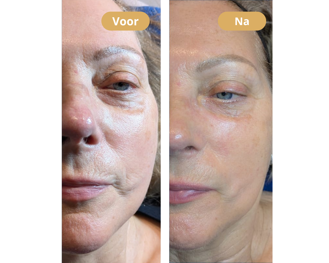 HydraFacial behandeling bij Dandon Skin Systems