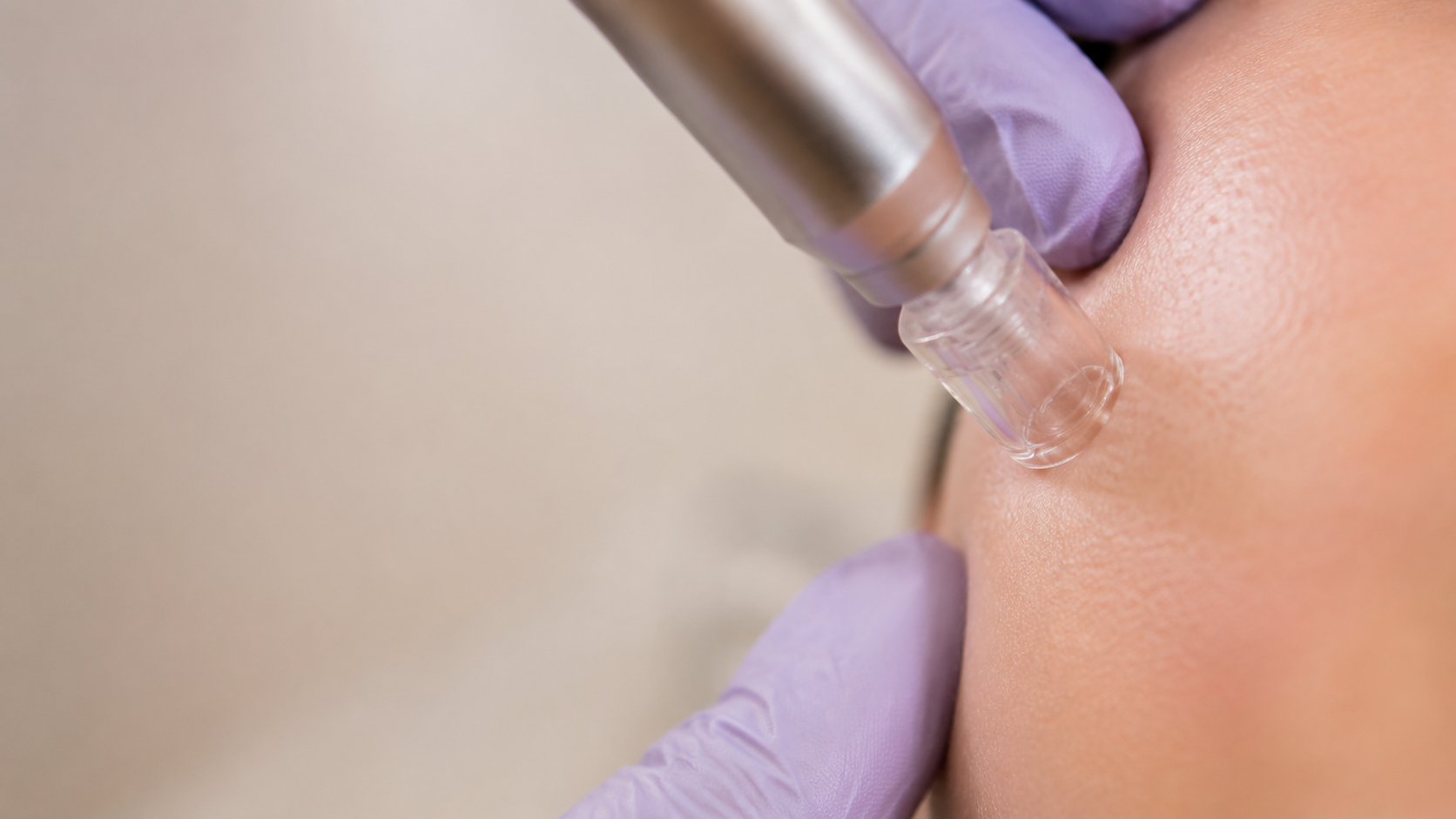 Microneedling en Galatea MedSpa